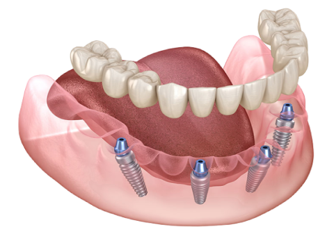 最少4本のインプラントで片顎のすべての歯の機能と見た目を手術当日に回復させる治療法です。
