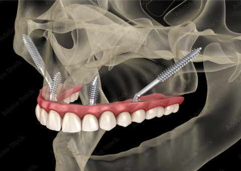 上顎骨が極端にやせていても、ザイゴマ（頬骨）にインプラントを埋め込む方法なら、手術当日に見た目と歯の機能を回復可能です。